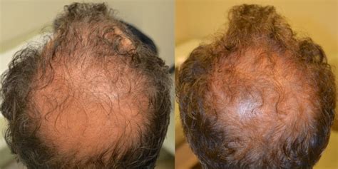 Propecia before and after photos - Dr Rogers - New Orleans