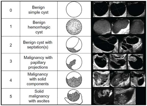 Women may not need to undergo surgery for non-cancerous ovarian cysts - https://debuglies.com