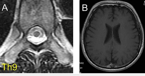 Spinal and brain MRI findings in patient 2 (A) A spinal MRI shows the... | Download Scientific ...