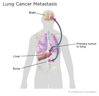 Lung Cancer Cells Diagram