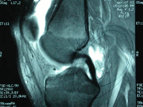 MRI of normal PCL, absent ACL and posterior loose bodies - Arizona ...