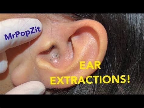 EAR EXTRACTIONS! Must see giant ear blackheads extracted. - YouTube | Skin care blackheads ...