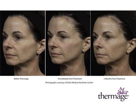 Thermage Skin Tightening - Radiance MedSpa Wheaton