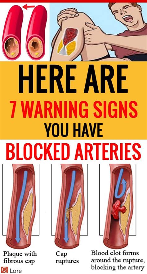 Here Are 7 Warning Signs You Have Blocked Arteries | Arteries, Warning signs, Signs