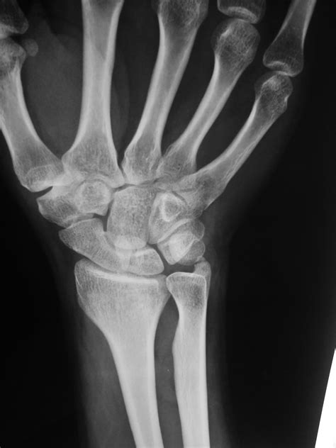 Ulnar Styloid