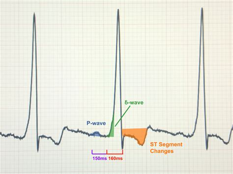 Asymptomatic Wolff-Parkinson-White Syndrome: Incidental EKG - JETem