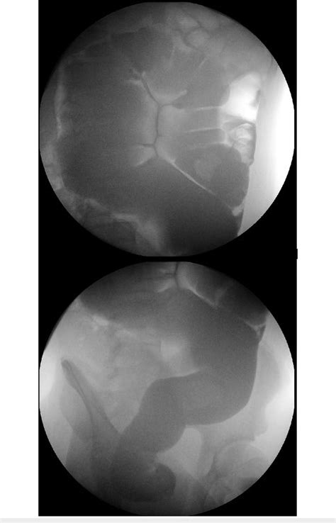 Contrast enema showing a redundant sigmoid colon with abnormal ...