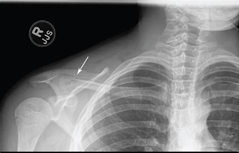 In pieces: Clavicle fracture | Radiology Key