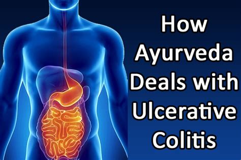 Herbal Remedies for Ulcerative colitis Archives - Planet Ayurveda