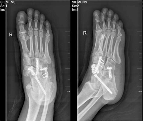 Postoperative radiograph with open triple fusion | Download Scientific Diagram