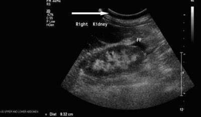 Perinephric Stranding Ultrasound