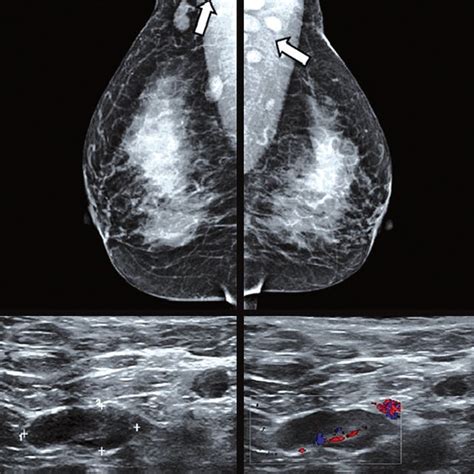 On the screening mammogram of a 50-year-old female patient, the MLO... | Download Scientific Diagram