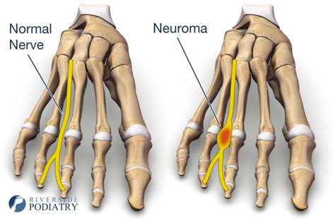 Morton’s neuroma - Riverside Podiatry