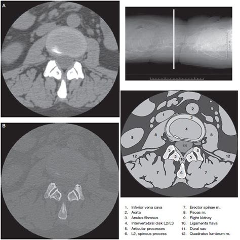 Lumbar Spine - Ct Scan - RadTechOnDuty