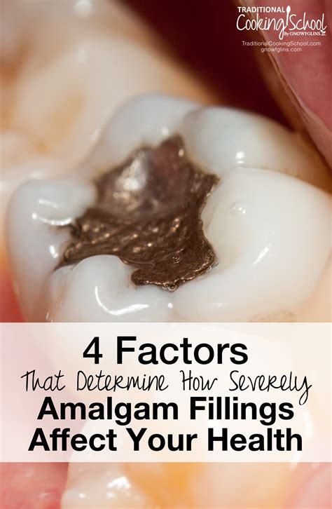 4 Factors That Determine How Amalgam Fillings Affect Health