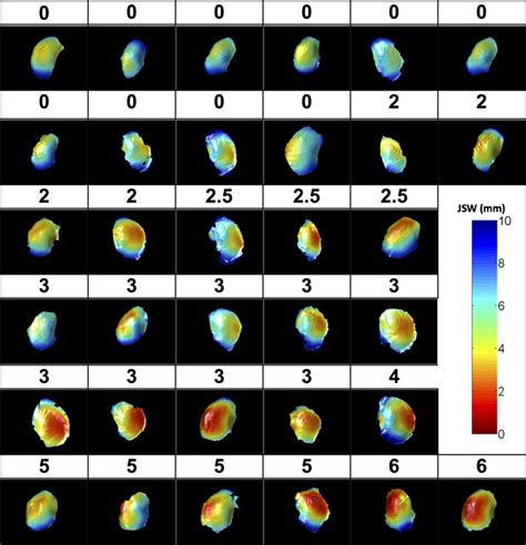 Correlations of Medial Joint Space Width on Fixed‐Flexed Standing Computed Tomography and ...