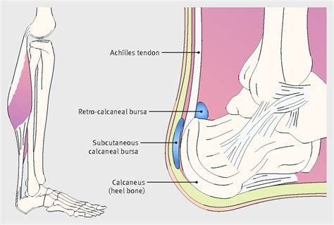 Pain at the back of the heel | The BMJ