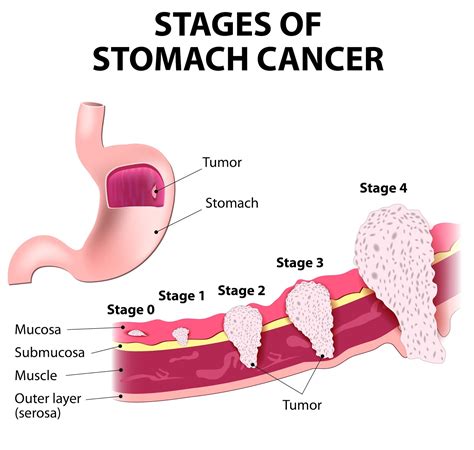 VIVA JOY HEALTH: GASTRIC Cancer