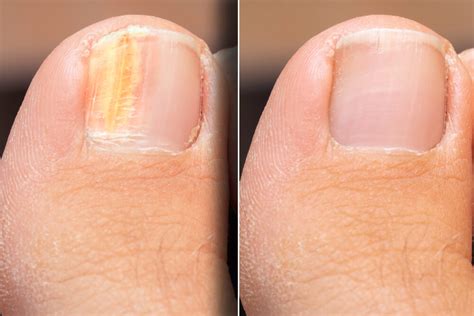 Causes and Treatments for Nail Fungus (Onychomycosis) - Step To Health