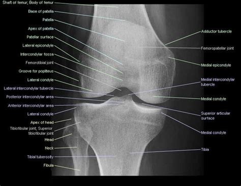 Tibial Tubercle Xray