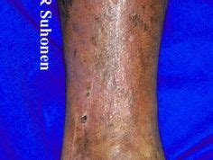 Lipodermatosclerosis | DermNet | Leg ulcers, Combination therapy, Vein surgery