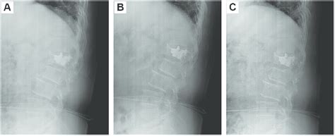 Long-term observation of PVP surgery for the treatment of a 74-year-old... | Download Scientific ...