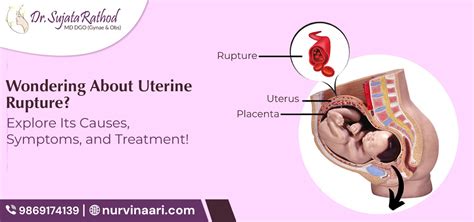 Uterine Rupture Unveiled: Causes, Symptoms, Treatment with Lady ...