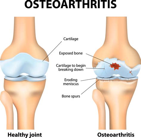 Osteoarthritis of the Knee | Orthopaedic Surgeon In Wantrina, Melbourne | Knox Orthopaedic Group