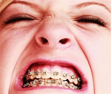 How to Make Your Braces Stop Hurting - Healthrow.net