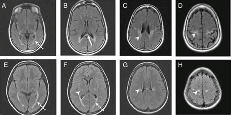 Brain MRI of patients numbered 1 (a-d) and 3 (e-h) showing the T2-Flair... | Download Scientific ...