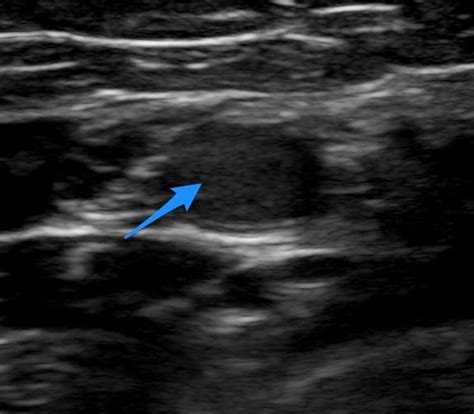 US4TW Case: 74F with Right Arm Tingling | Ultrasound for the Win series