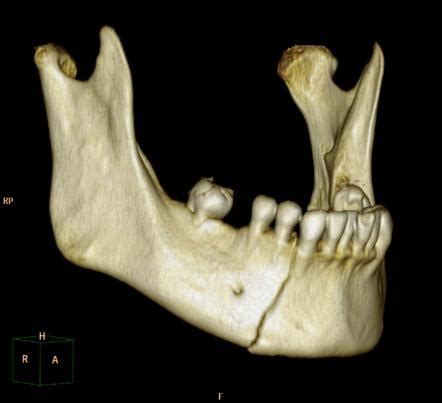 Mandibular fracture | Radiology Reference Article | Radiopaedia.org