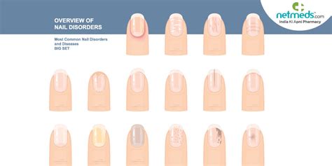 Varied Colours Of The Nail: Know What They Indicate About Your Health?