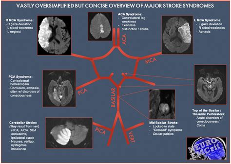 Stroke Mimics: A Review – Sinai EM