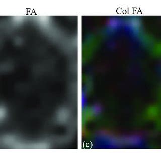 | (a) T2-weighted image. (b) Fractional anisotropy map. (c) Color... | Download Scientific Diagram