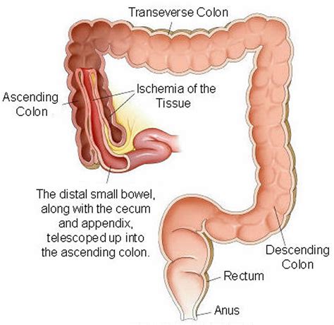 Intussusception Causes, Symptoms, Diagnosis, Treatment