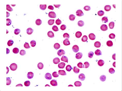 Peripheral smear from hospital day 1 showing intracellular ring forms ...