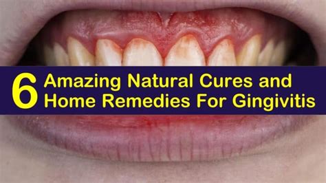 6 Natural Cures and Home Remedies For Gingivitis