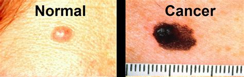 BabaMail -Important: Learn how to spot A Cancerous Mole.