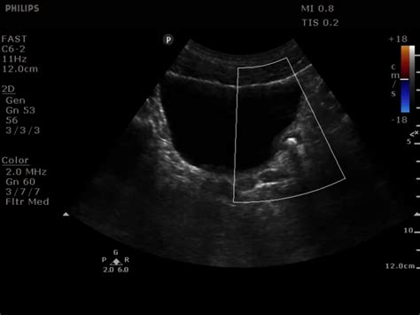 Choosing Wisely: Ultrasound For Suspected Nephrolithiasis — TPA