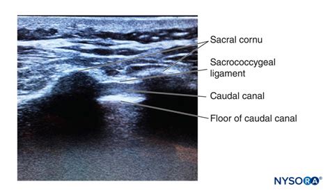 regional-anesthesia-ultrasound-image-depicting-the-sacral-cornua ...