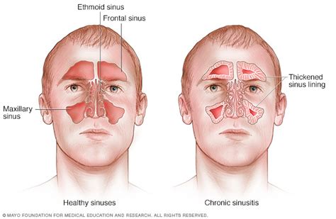 Chronic sinusitis Disease Reference Guide - Drugs.com