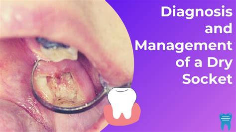 What is a Dry Socket? | Diagnosis and Management - YouTube