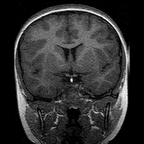 Ectopic neurohypophysis | Image | Radiopaedia.org