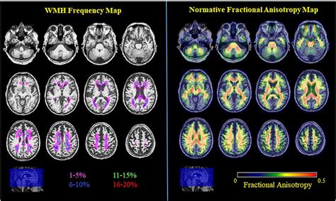 Frontiers | White Matter Regions With Low Microstructure in Young Adults Spatially Coincide With ...