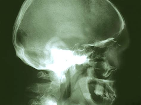 Geographic variation in HPV oropharyngeal cancer prevalence