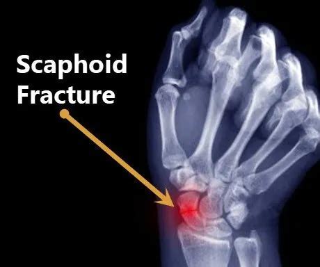 Scaphoid Fracture Cast Time