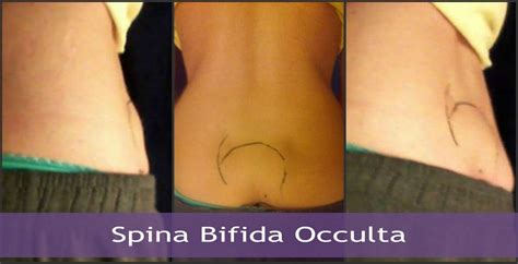 Spina Bifida Occulta - Chiari Bridges