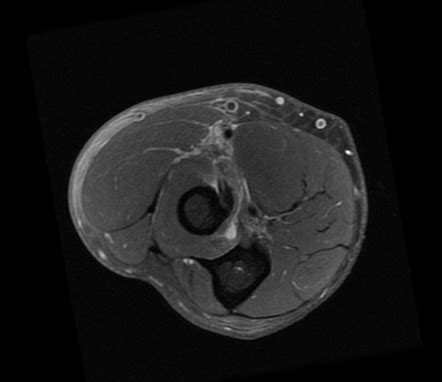 Distal short head biceps tendon tear (MRI) | Radiology Case ...