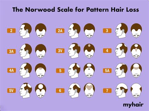 The Norwood scale (What it is and how it’s used) - myhair